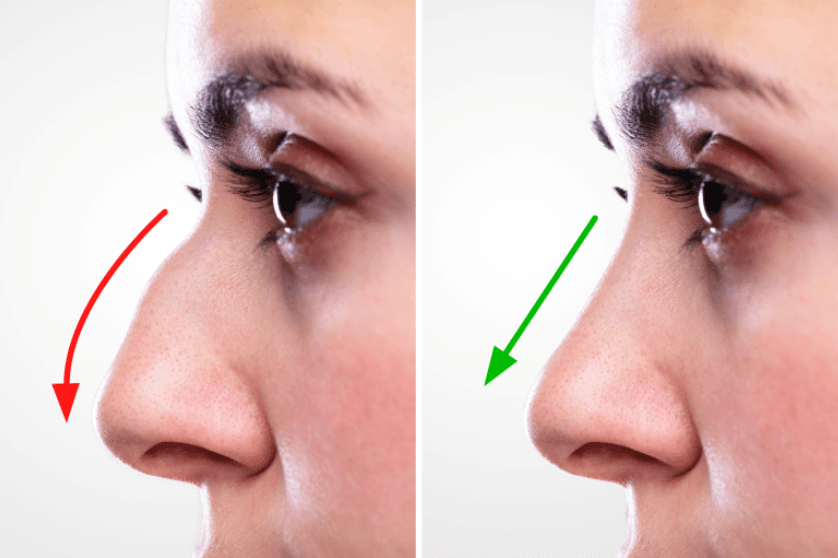 Rhinoplasty Surgery
