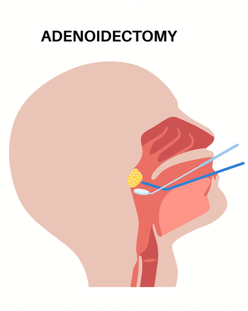 Adenoidectomy
