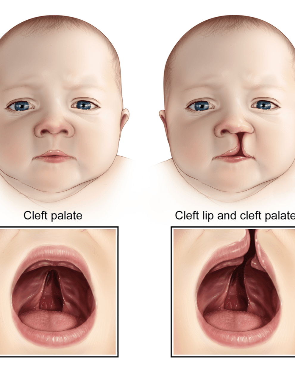 Cleft Palate Repair Surgery