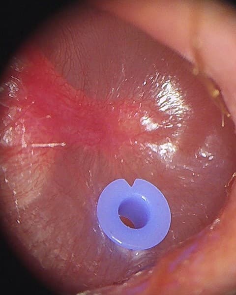Myringotomy & Grommet Insertion