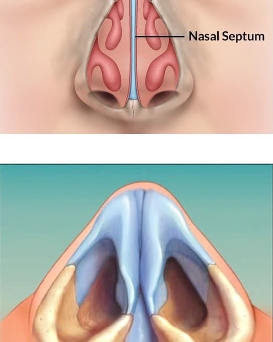 Septal Surgery