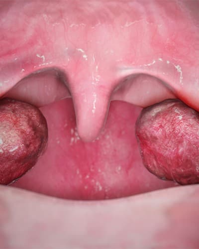 Tonsillectomy