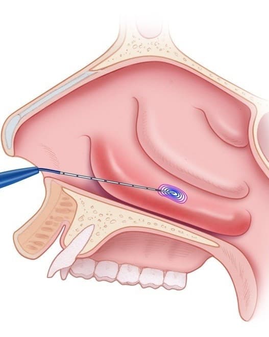 Turbinectomy & Turbinoplasty